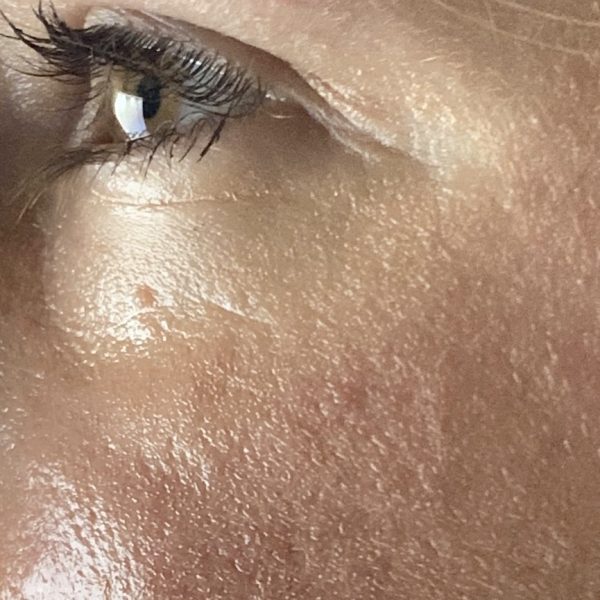 facial-profile-rosacea-caitlin-past-skin-issue